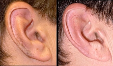 Male Ears