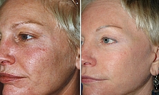 Skin Rejuvenation