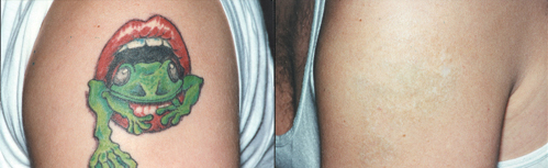 tattoo_removal1