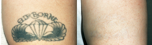 tattoo_removal3