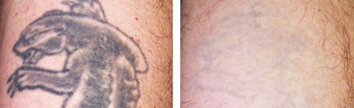 tattoo_removal5