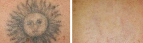 tattoo_removal6