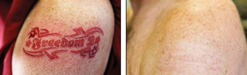 tattoo_removal7