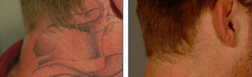 tattoo_removal8