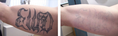 tattoo_removal9